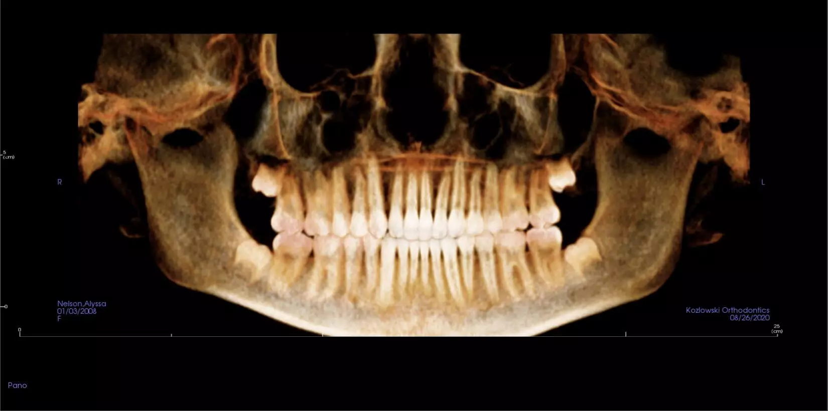 x-ray of teeth after pan