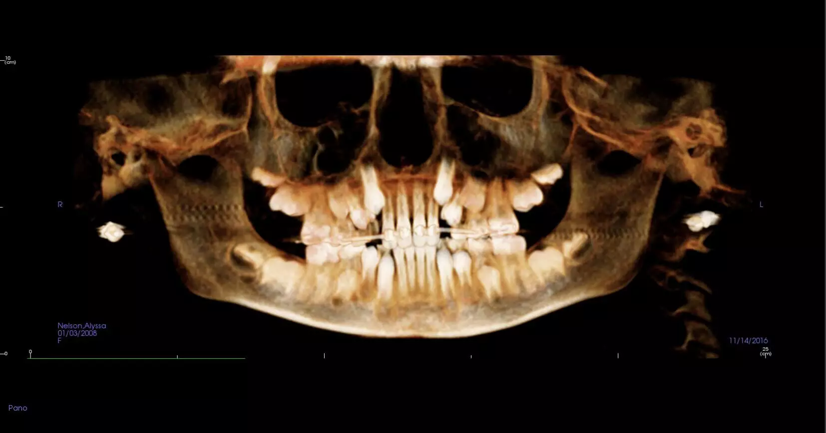 x-ray of teeth before pan